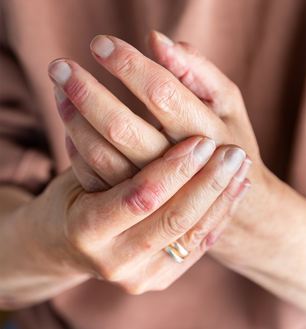 woman with eczema on her hands